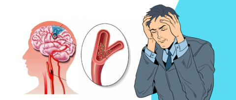 种由于脑血管突然"破裂"或者"阻塞"而引起脑组织损伤的急性脑血管病变